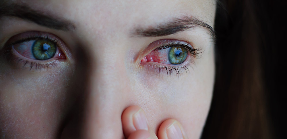 Alergia ocular